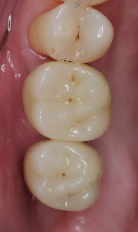 Deux implants remplaÇant des dents postérieures manquantes

