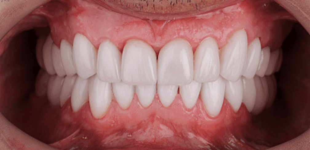 Smile after cosmetic treatment
