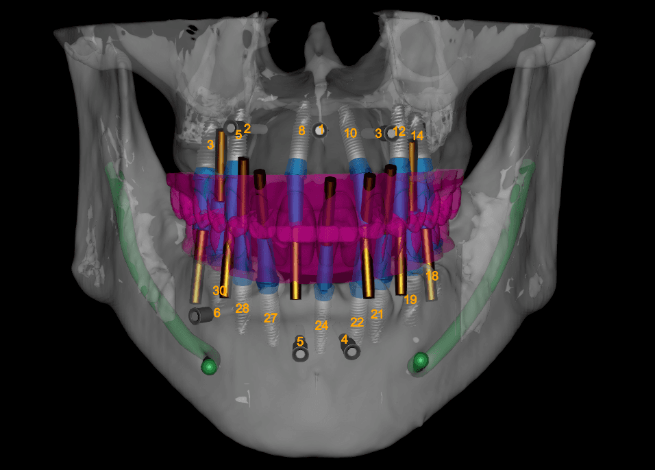 Digital Treatment Planning