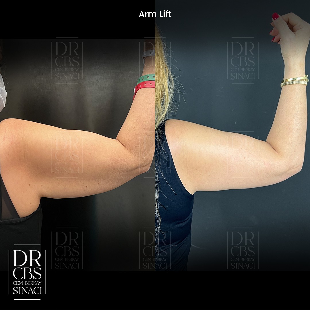 before after arm lift 2 months post-op right arm back view