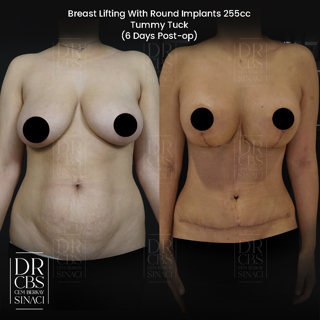 breast uplift with implant and abdominoplasty tummy tuck before after front view