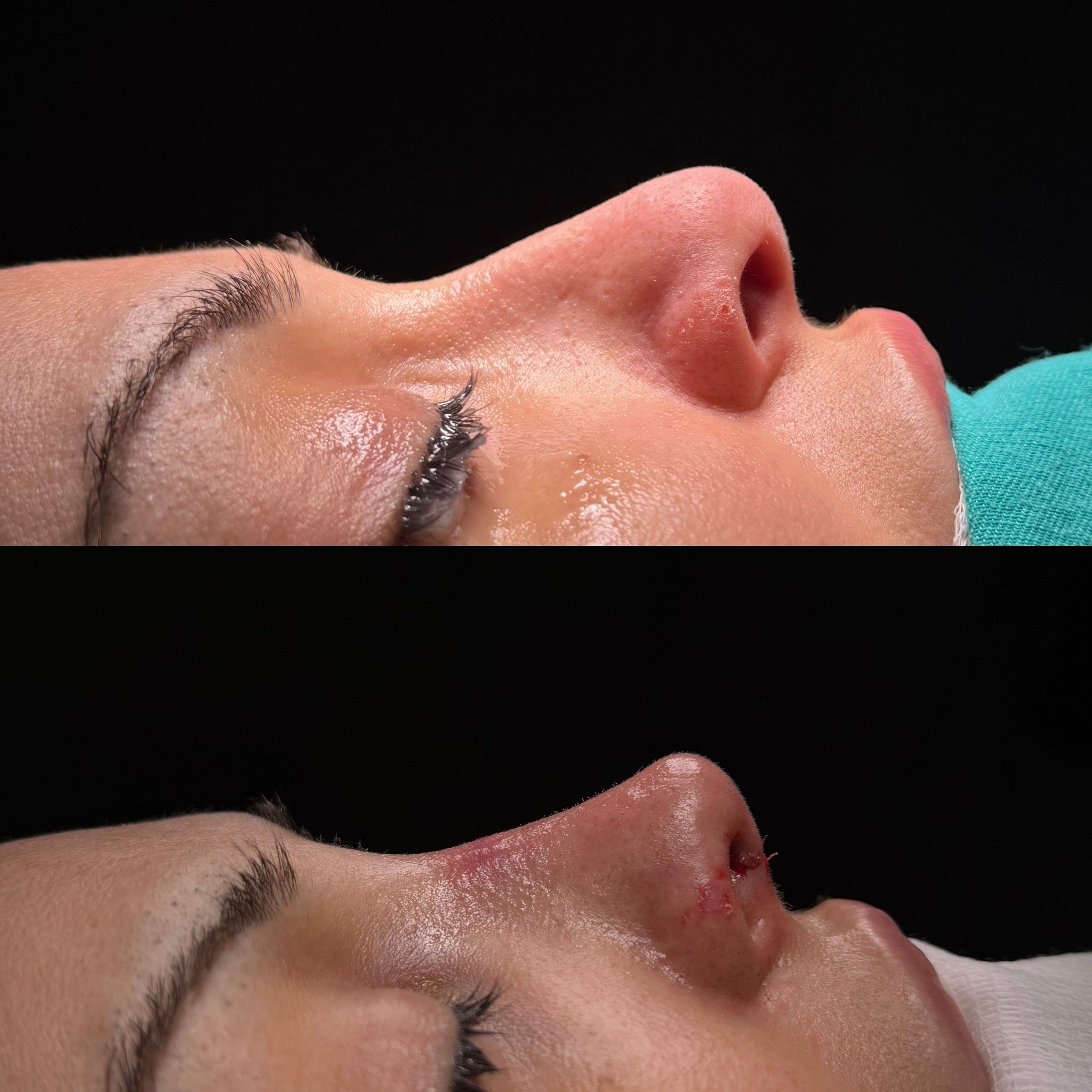 ultrasonic rhinoplasty before after in istanbul