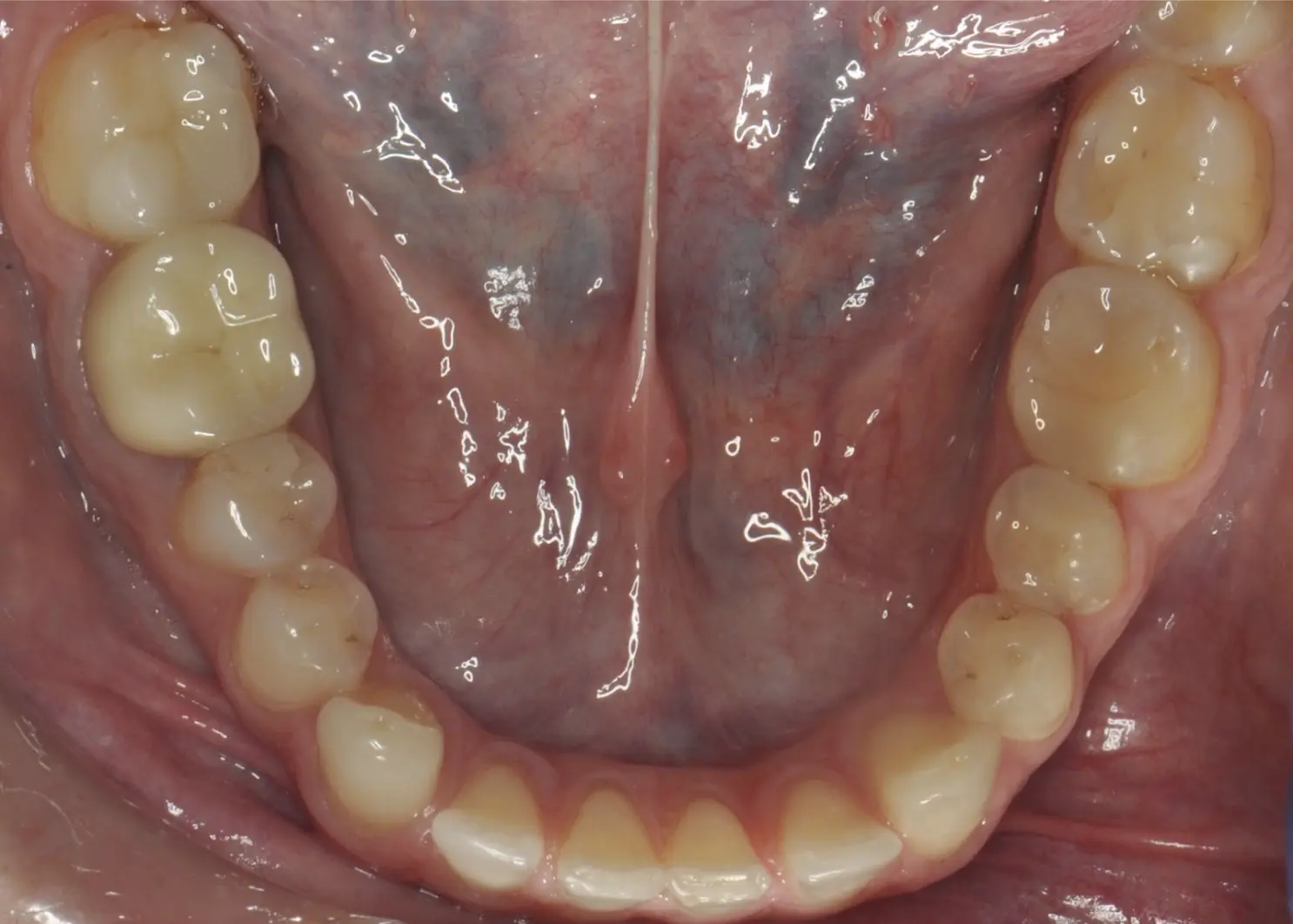 Before and after definitive ceramic restorations (crowns, veneers)