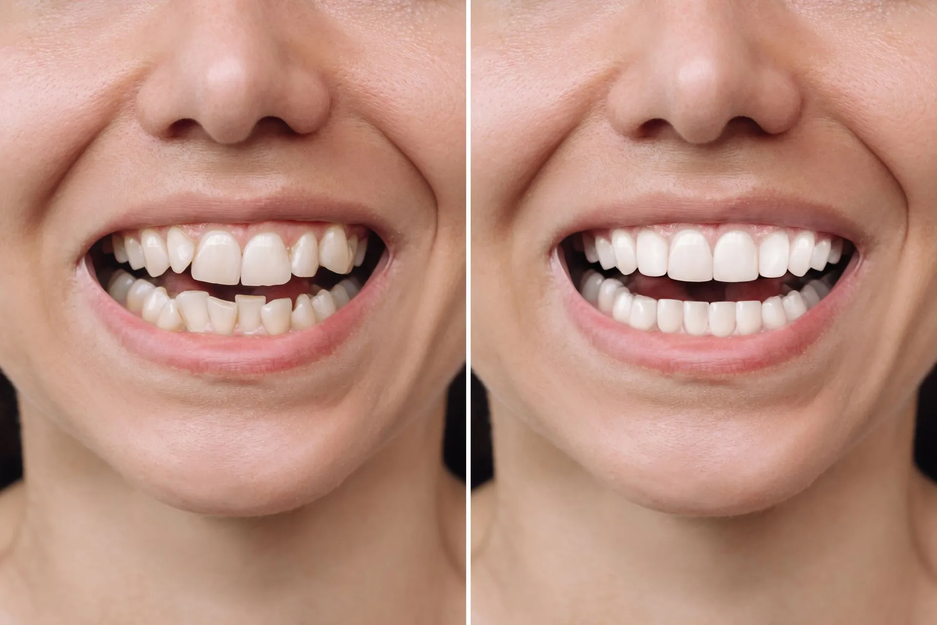Dental Veneers: the solution to correct imperfections