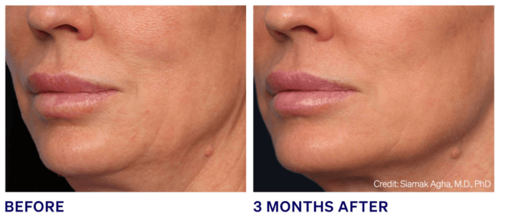 loose skin after weight loss treated with Ellacor