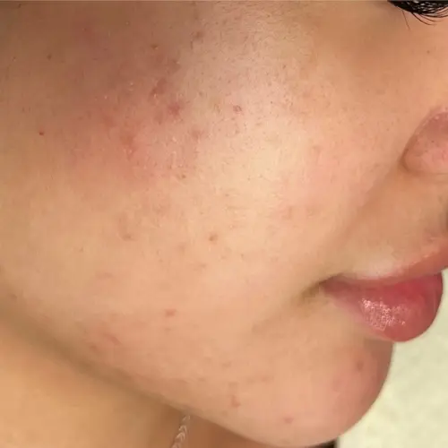 After growth factors treatment at The Vancouver Aesthetician — acne scars and craters visibly repaired, inflammation resolved and skin smooth, clear and healthy