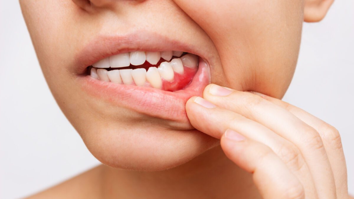 dental infection