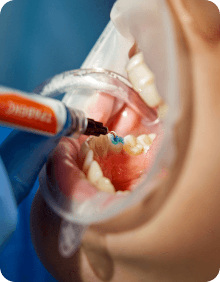 boca aberta com foco no tratamento de canal