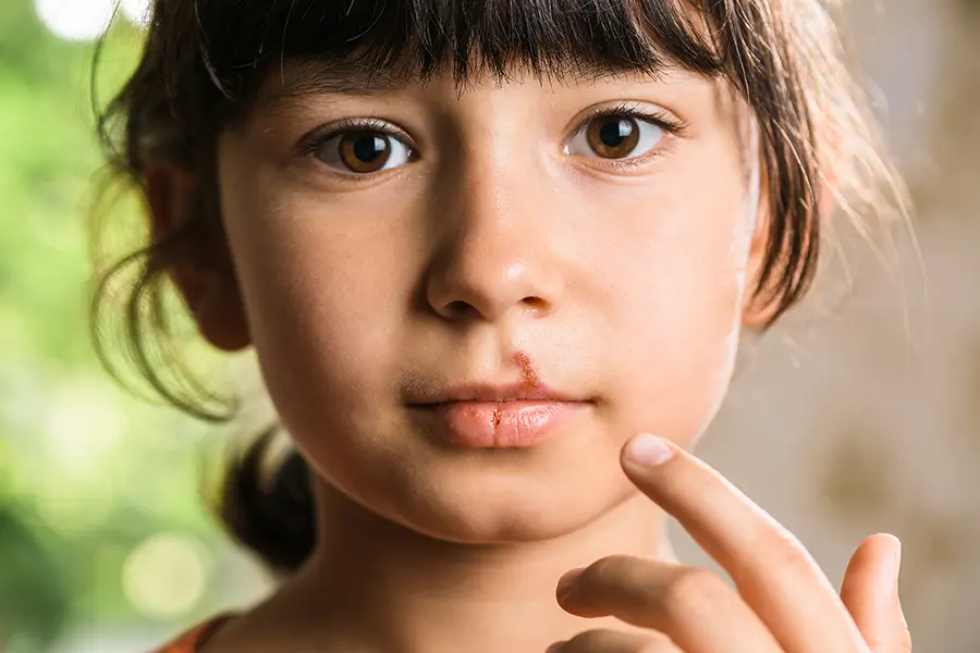 Child with Cold Sore