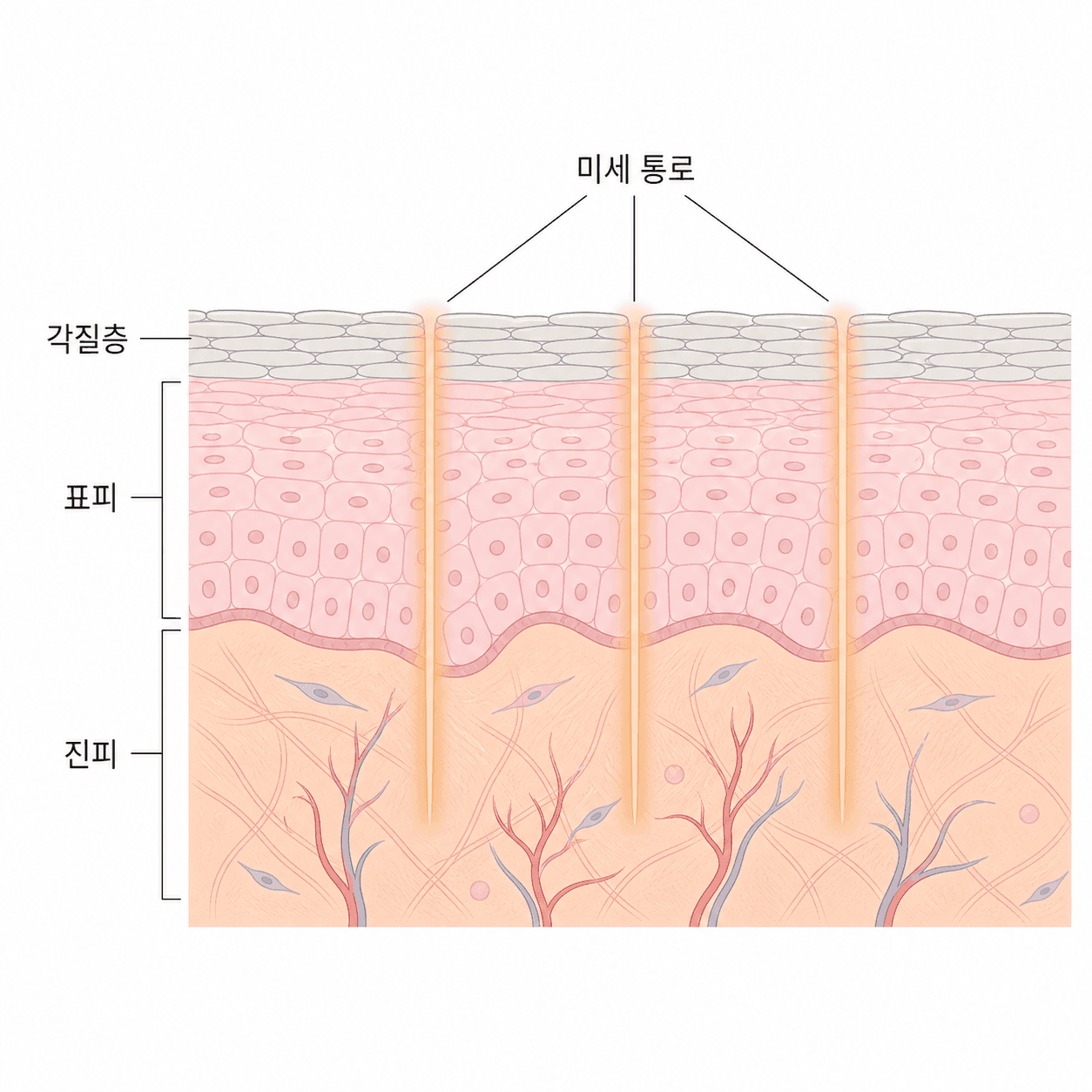 미세 통로가 열려 있는 동안 얇아지는 방어벽