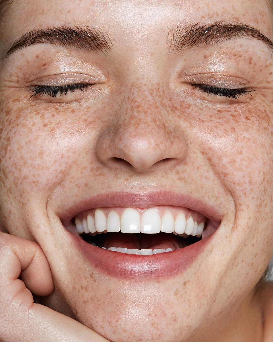 Facets (Oral Rehabilitation)