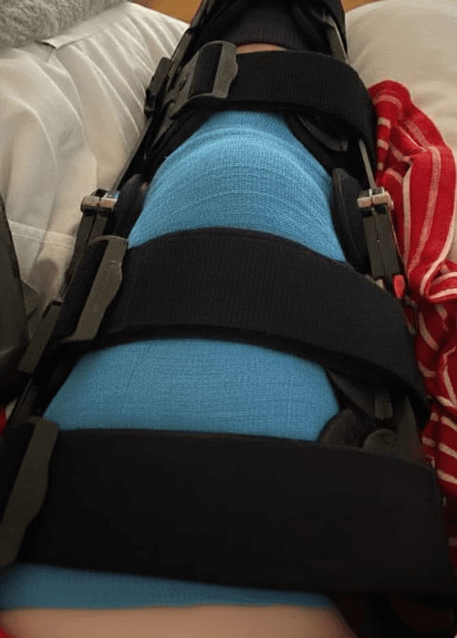 Knee brace after ACL reconstruction