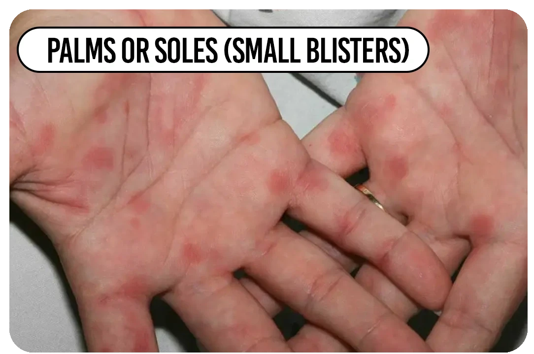 Palms or soles (small blisters)