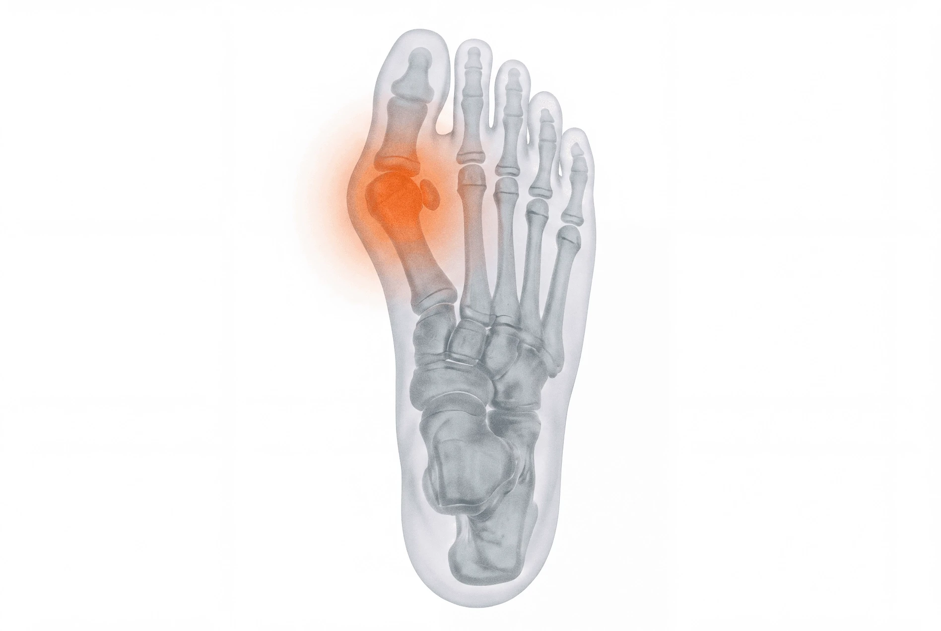 Child Bunions Paeds