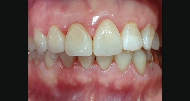 모델리스로 작업한 지르코니아 세팅 사진