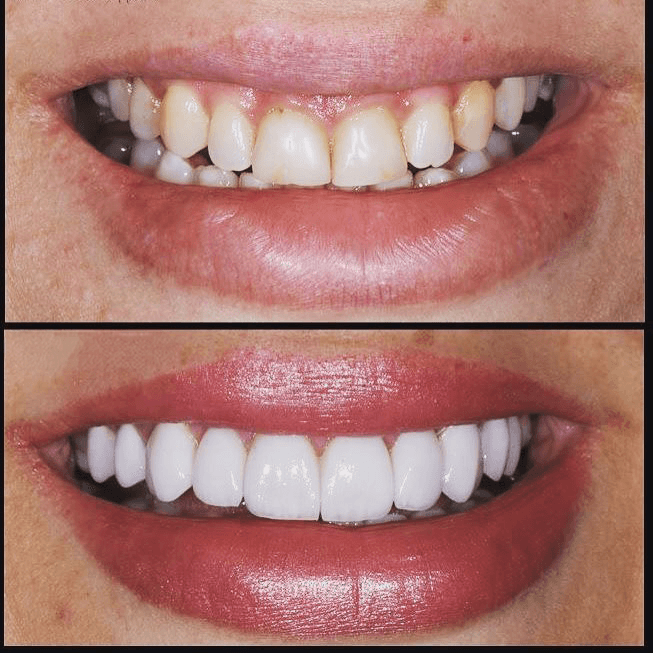 Dental veneers Dubai before-and-after showing improved teeth colour, an aligned smile, and enhanced overall facial appearance.
