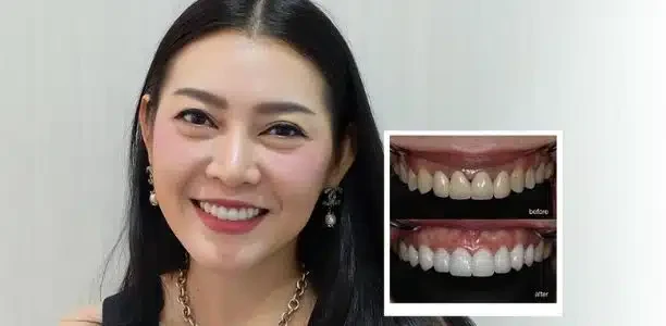 Dental crown restoration at COSDENT Smile Design