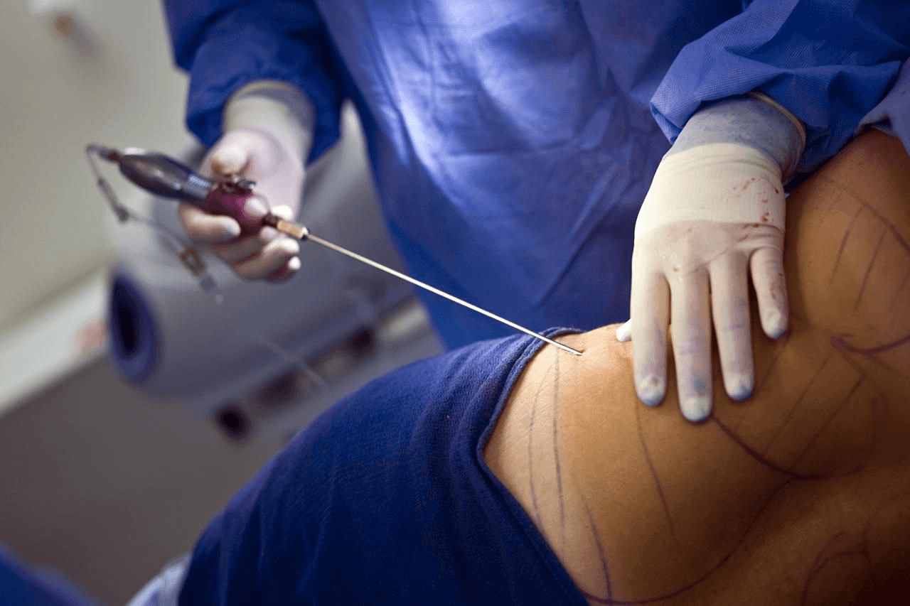How Long Does Liposuction Last? Are the Results Permanent?