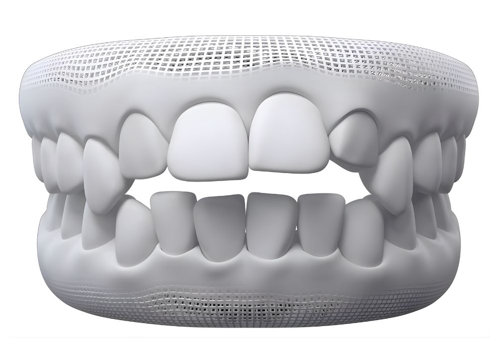 3D dental model showing misaligned bite associated with jaw pain and uneven pressure on teeth.