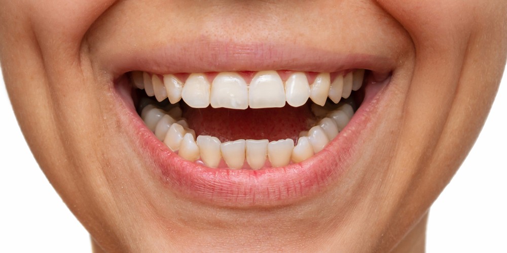 Fogászati esztétika előtte–utána – mosoly átalakítás