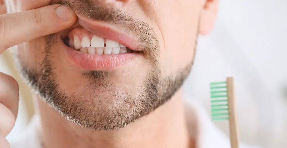 Retração Gengival e o seu tratamento