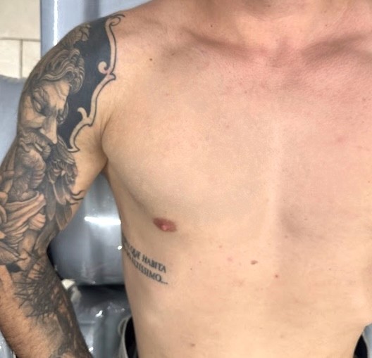Imagem de antes e depois da remoção de tatuagem