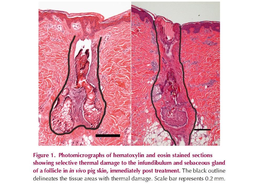 Acne Treatment Based on Selective Photothermolysis of Sebaceous Follicles with Topically Delivered Light-Absorbing Gold Microparticles