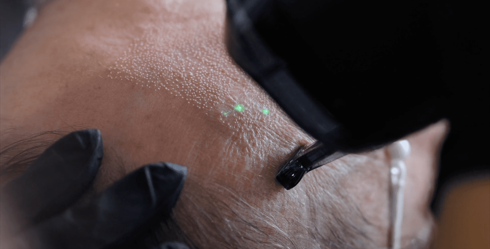 L'équipement de resurfaçage au visage d'une patiente montrant de très près le résultat