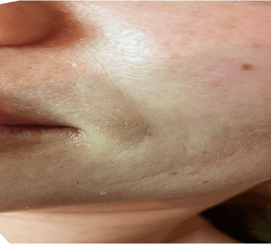 After treatment result