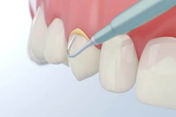 Intraoral Cameras