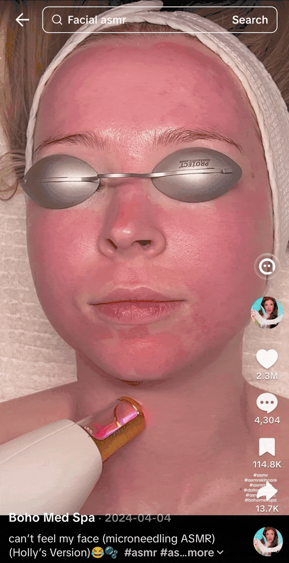 resurfx fractional laser gif for customers