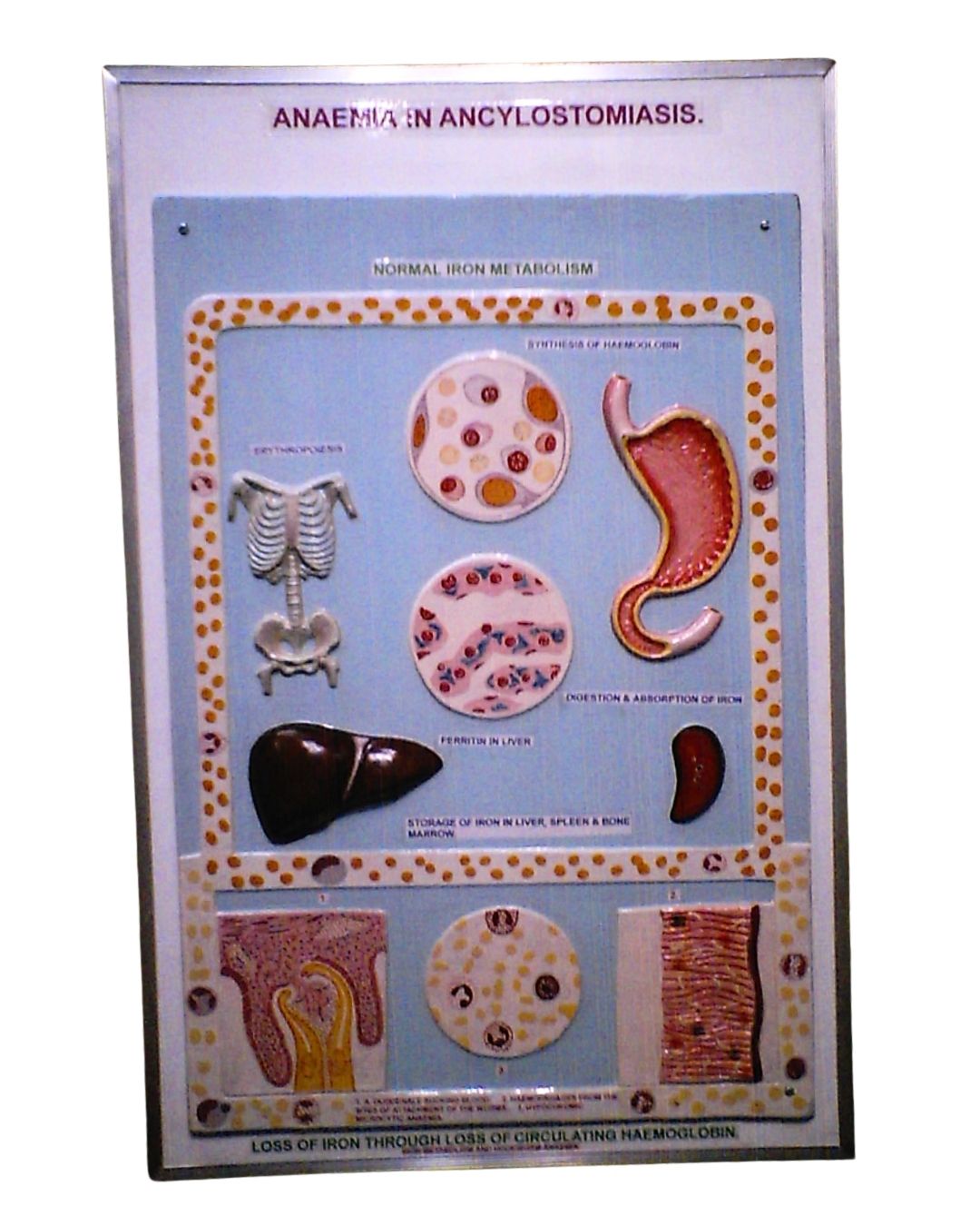 Anaemia in Ancylostomiasis