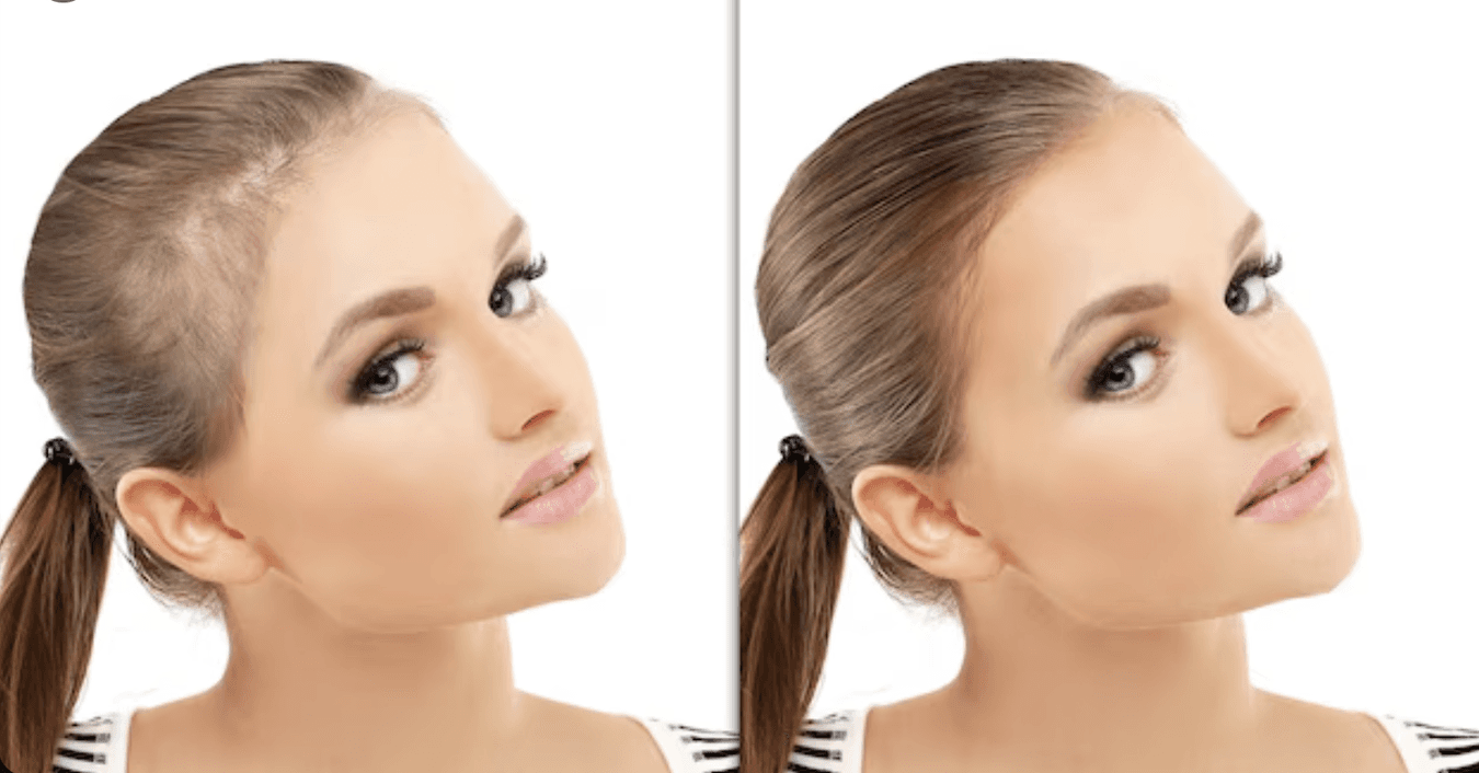 Female Hair Transplant 