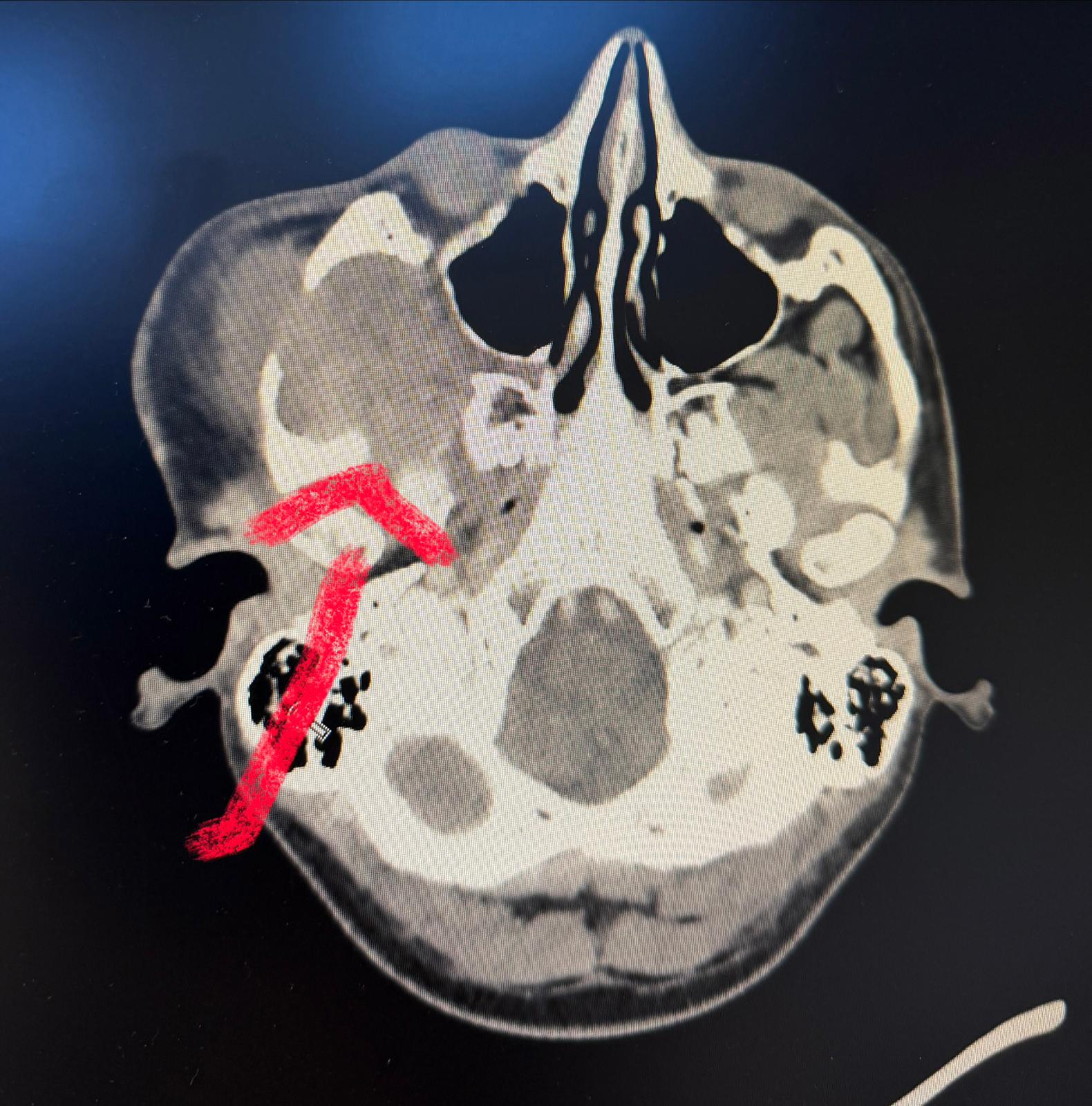 FOTO: Tumora infiltreaza regiunea profundǎ a craniului posterior de ochi şi fosa infratemporalǎ