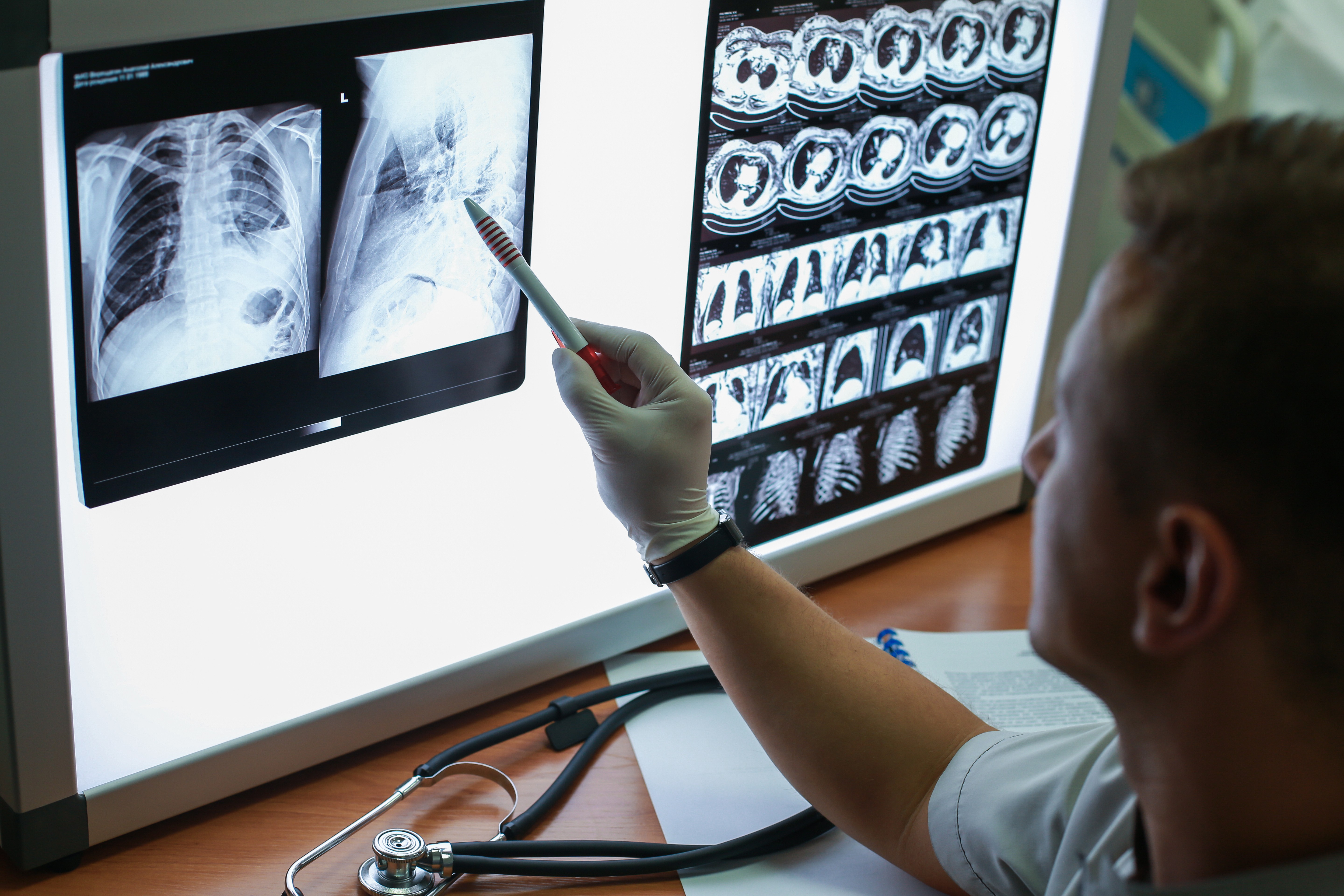 Doctor in gloves pointing a pen at chest X-rays and CT scan images on a backlit viewing panel