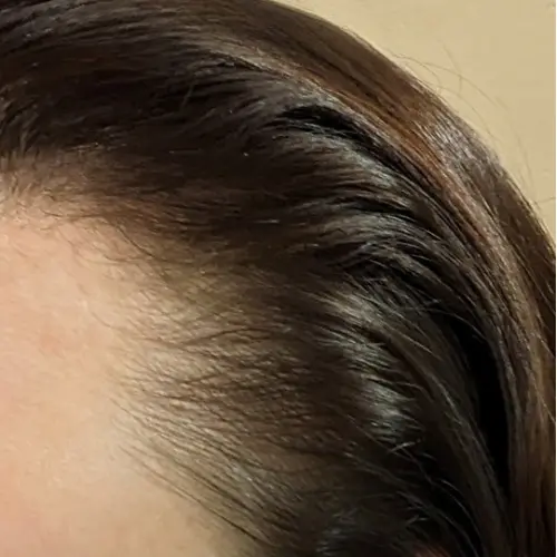 After HydraFacial MD scalp treatment at The Vancouver Aesthetician — visibly thicker, fuller, and healthier hair growth restored naturally