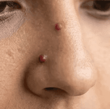 Angioma removal in winnipeg by Dermagraphics Skin Studio