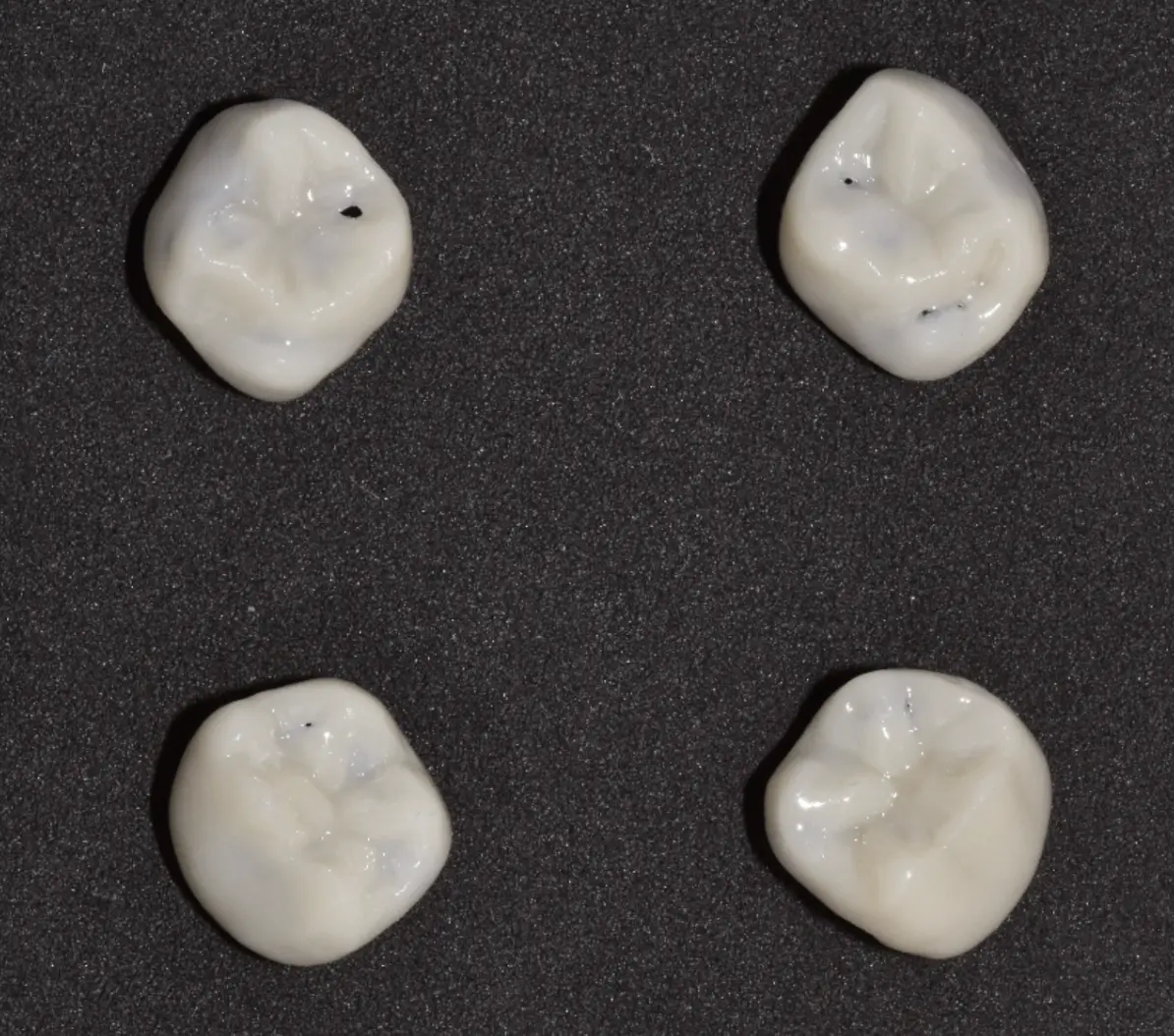 3D-gedruckte Onlays, bereit für die Zementierung
