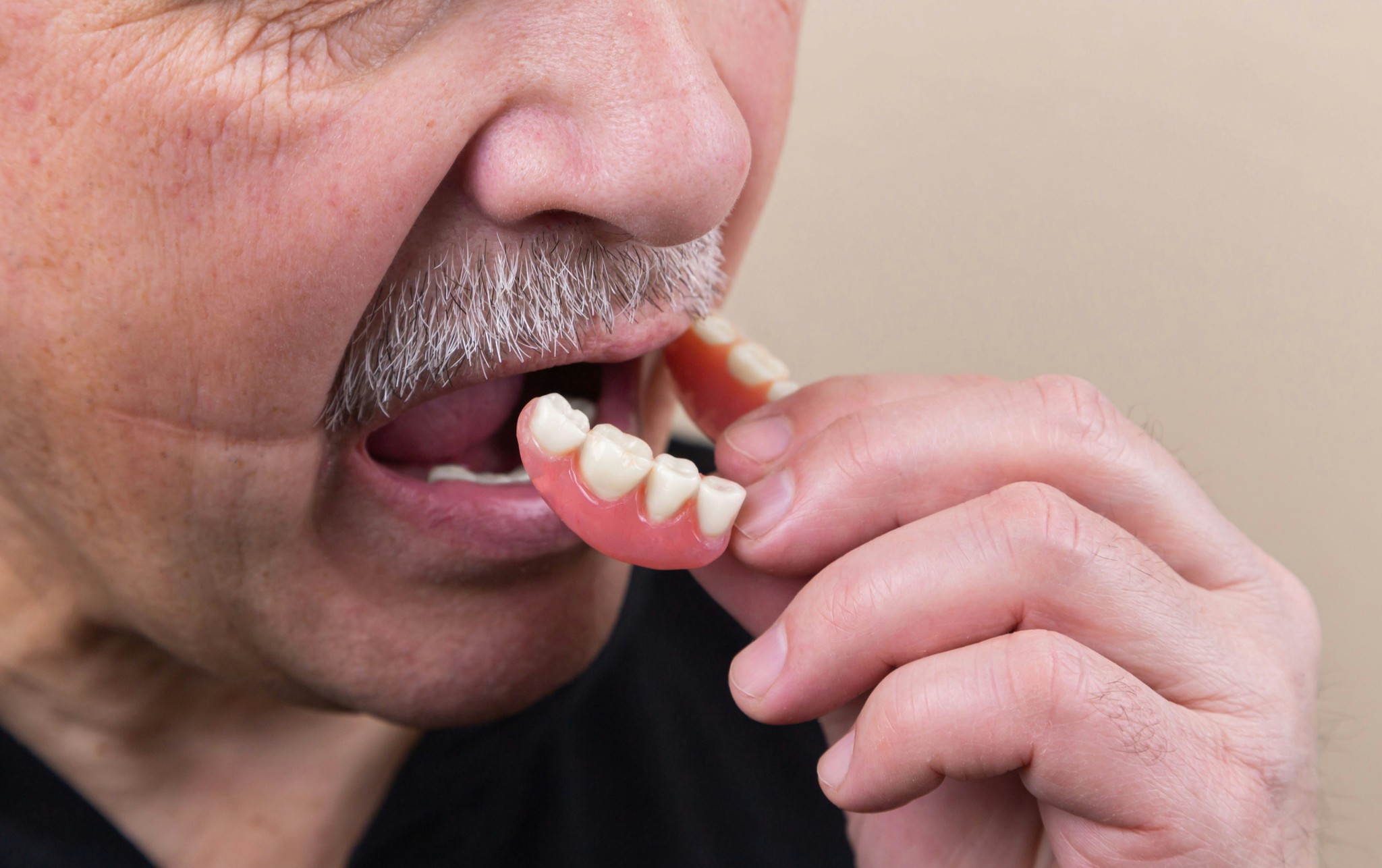 dental bridges