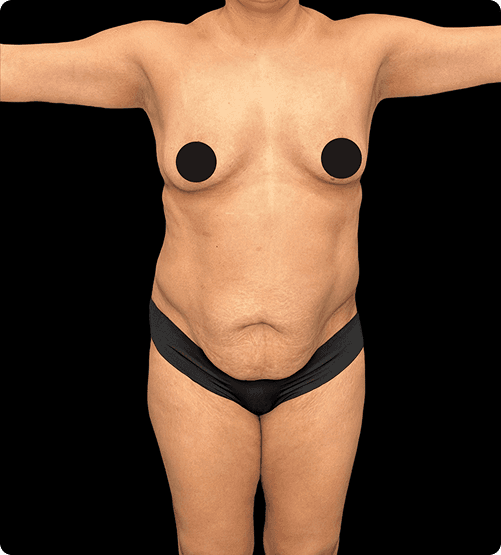 ABDOMINOPLASTIA - BEFORE