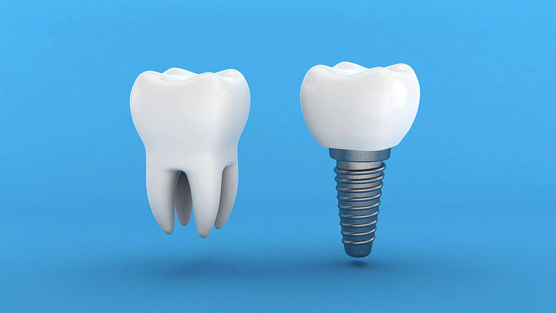 dental implants