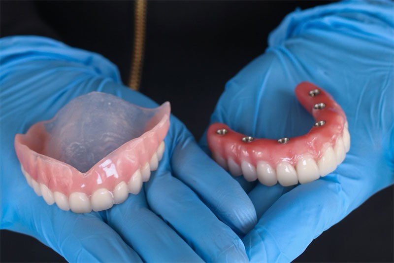 dental implants vs dentures