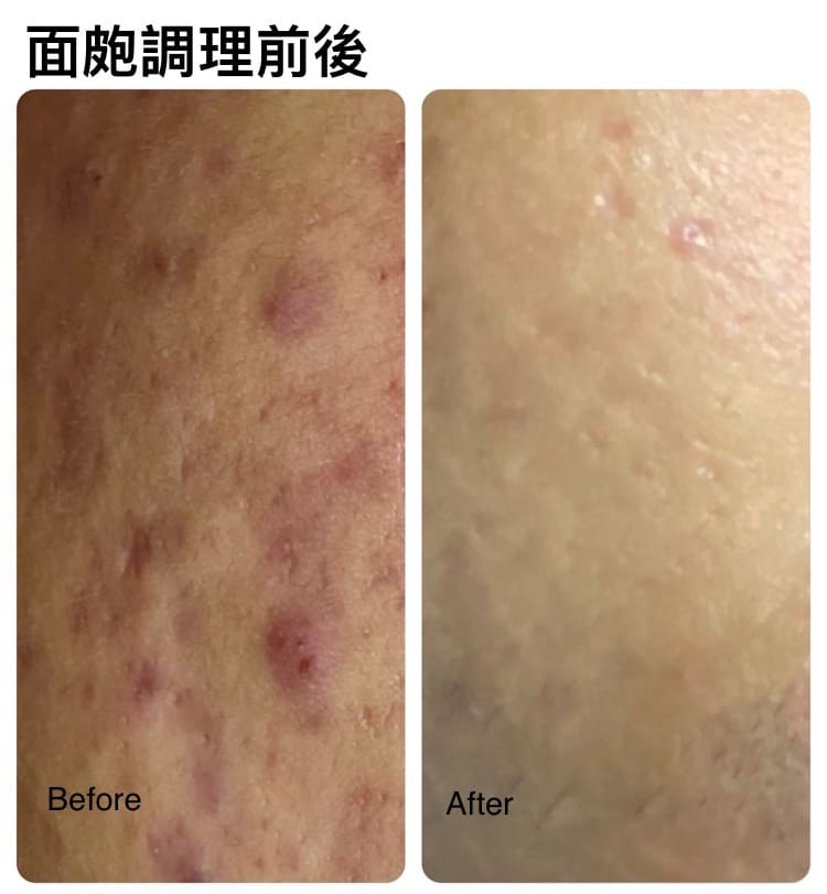 面皰調理前後