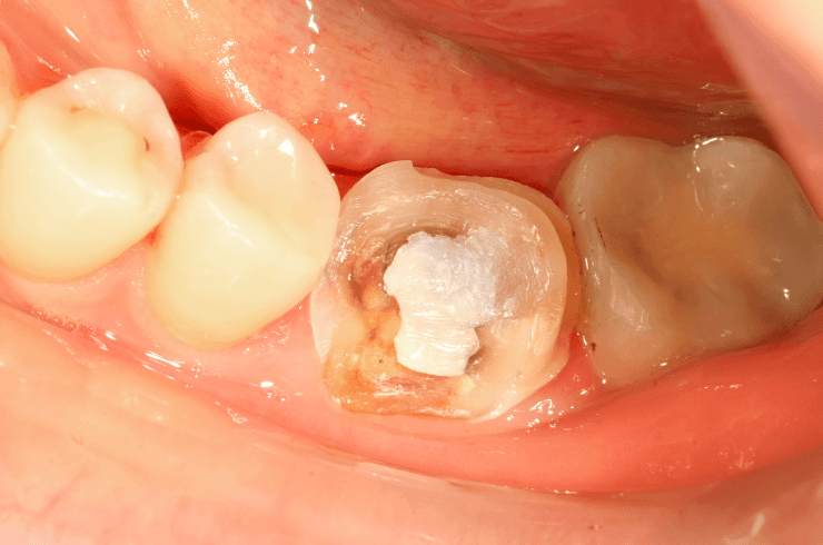 teeth restoration