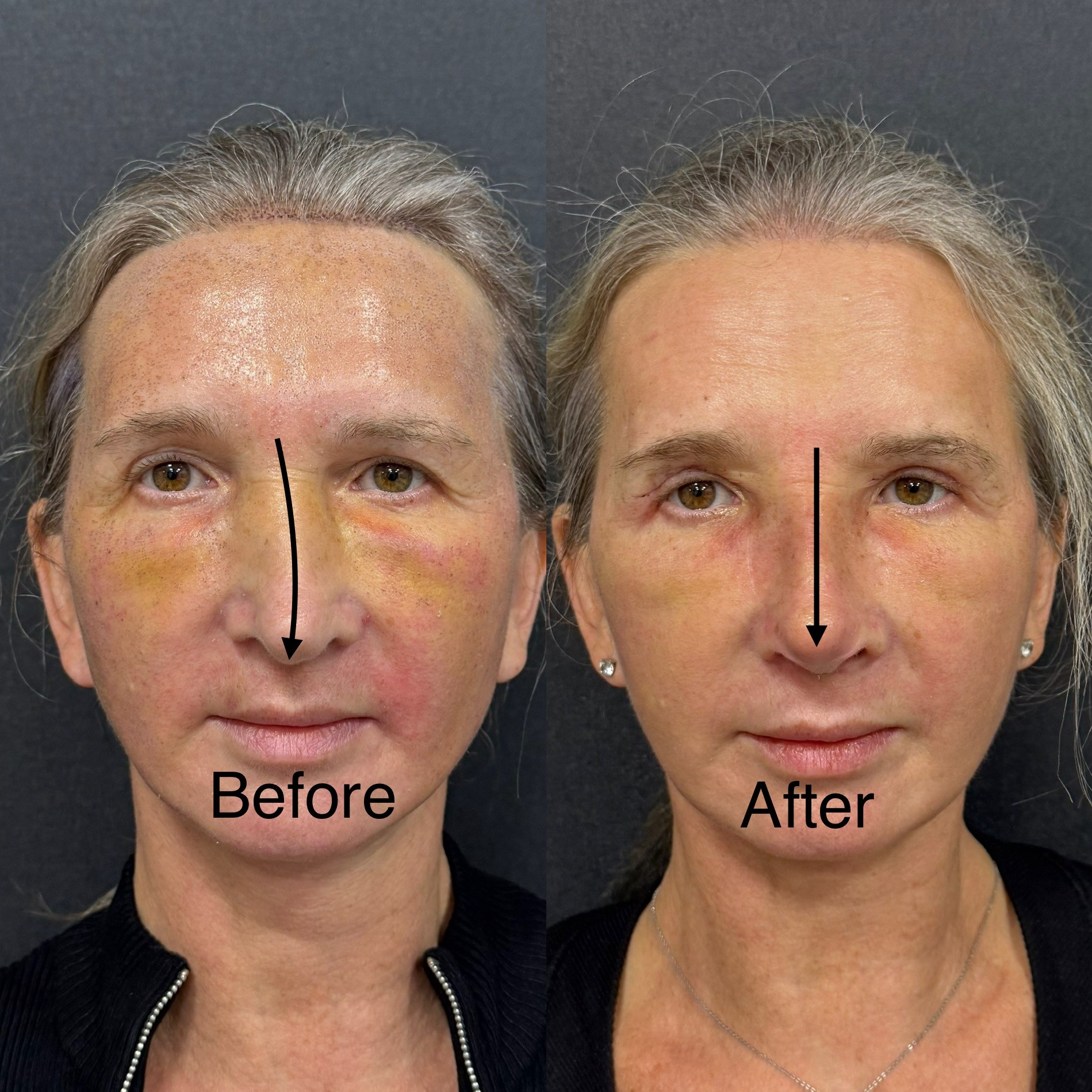 revision rhinoplasty deviation fixed before after 5 days post-op front view