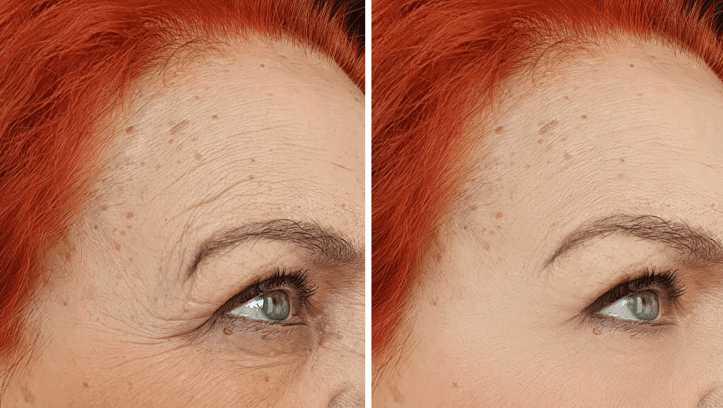 Does Botox Make You Look Fake? Here’s the Truth