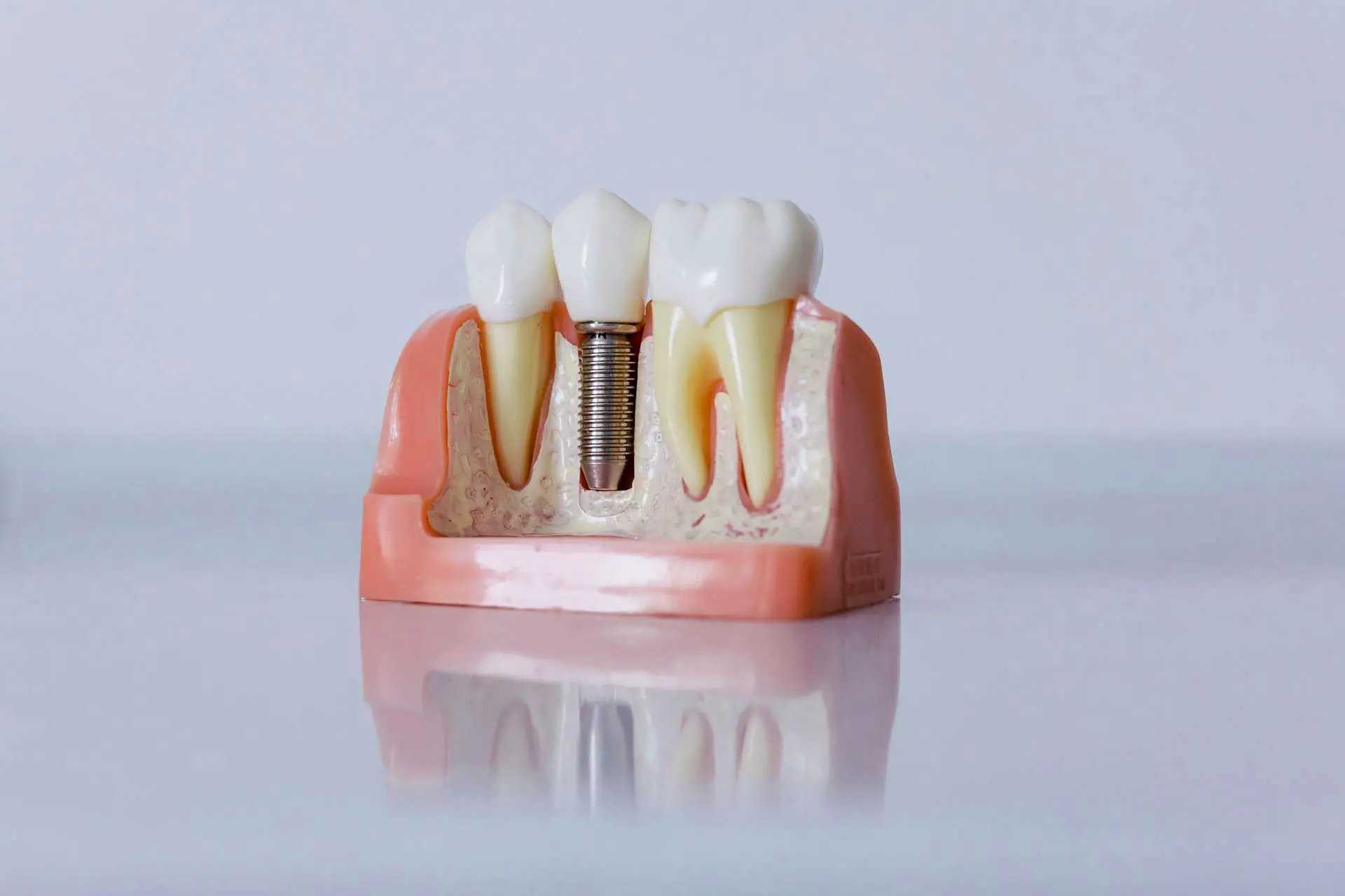 A close-up of a dental impression tray holding several tooth on a reflective surface.