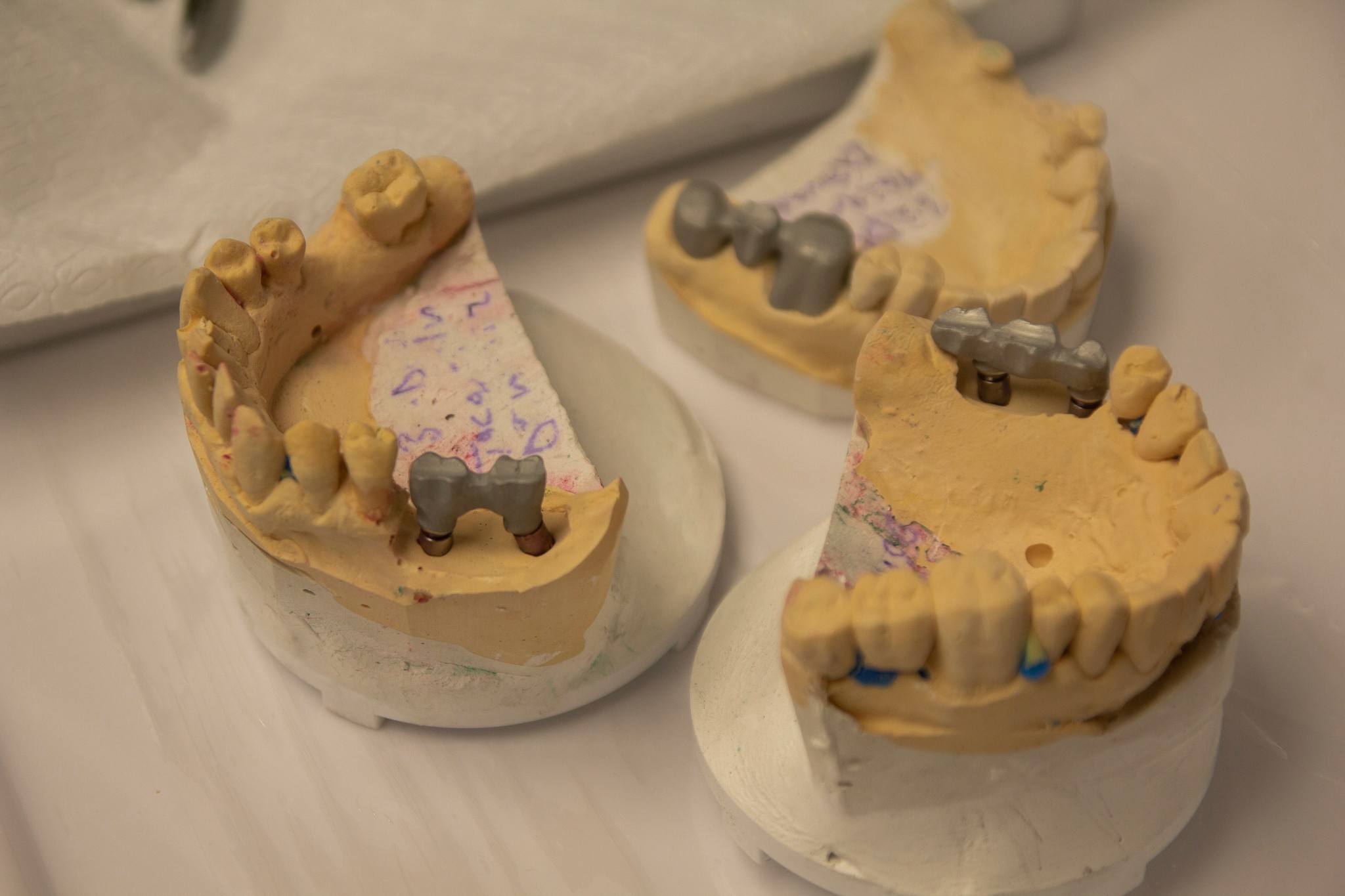 Root Canal Therapy