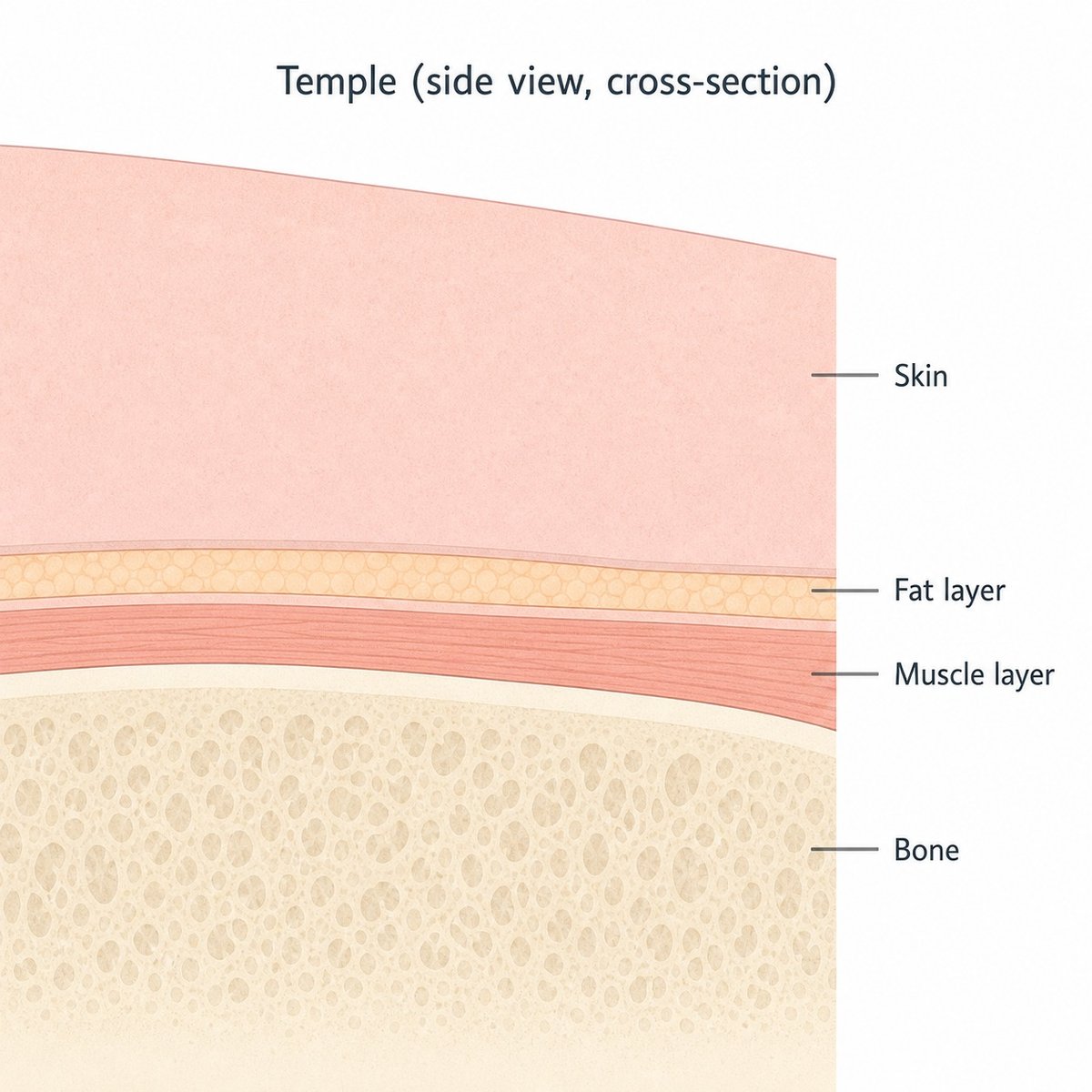 Cross-section diagram of the temple showing skin, fat, muscle, and bone thinning together