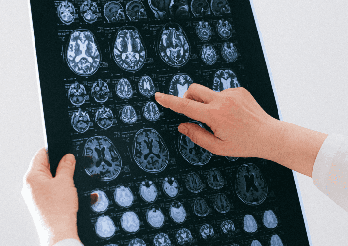 Doctor pointing at brain scan images on a medical film sheet.